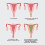 staphylococcus pelvic inflammatory disease