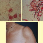 staphylococcus saprophyticus urinary tract infection