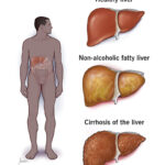 steatosis of liver