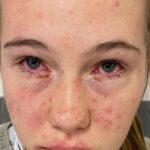 stevens-johnson syndrome