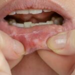 stomatitis