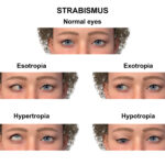 strabismus
