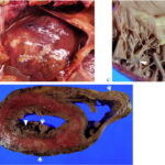 streptococcal endocarditis