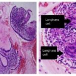 streptococcal endometritis