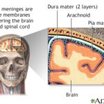streptococcal meningitis
