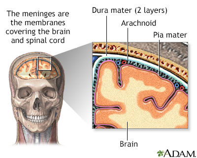 streptococcal meningitis