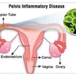 streptococcal pelvic inflammatory disease