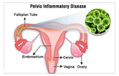 streptococcal pelvic inflammatory disease
