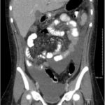 streptococcal peritonitis
