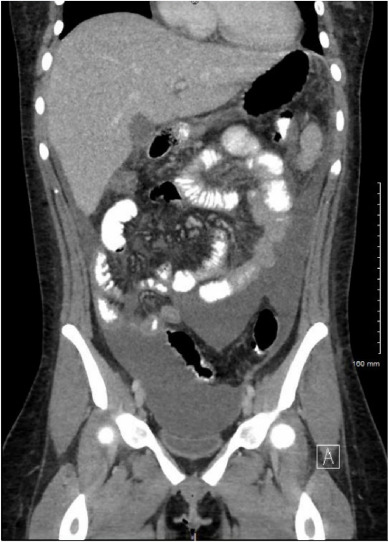 streptococcal peritonitis