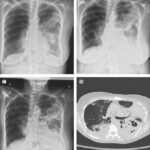 streptococcal pneumonia