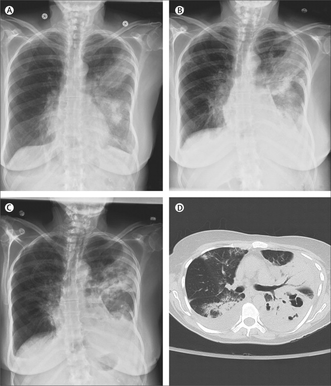 streptococcal pneumonia