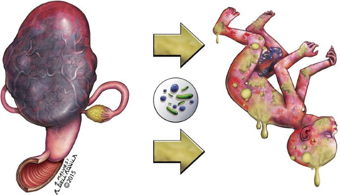 streptococcal septic abortion