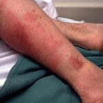 streptococcal septicemia