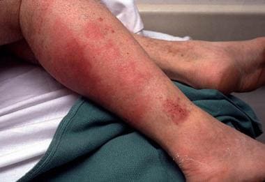 streptococcal septicemia