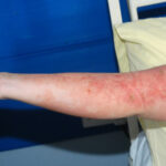 streptococcal toxic shock syndrome