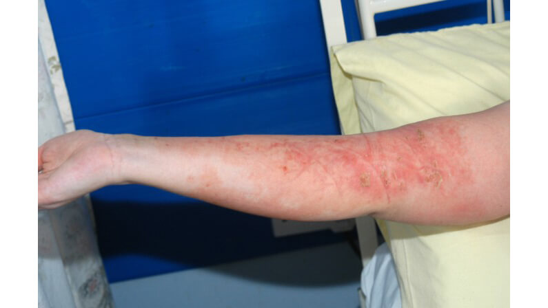 streptococcal toxic shock syndrome