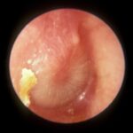 streptococcus acute otitis media