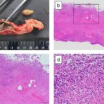 streptococcus complicated appendicitis