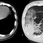 streptococcus lung abscess