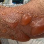 streptococcus myositis