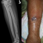 streptococcus osteomyelitis
