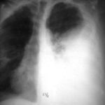 streptococcus pneumoniae bronchitis