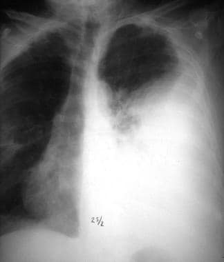 streptococcus pneumoniae bronchitis
