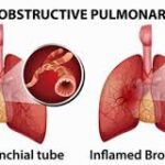 streptococcus pneumoniae chronic bronchitis