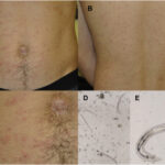 strongyloidiasis