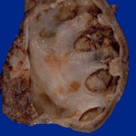 struvite renal calculi