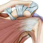 subacute bursitis