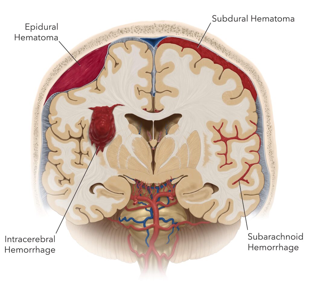 subarachnoid intracranial hemorrhage