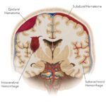 subarachnoid intracranial hemorrhage