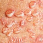subcorneal pustular dermatosis