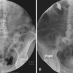 subcutaneous urography adjunct for contrast resorption