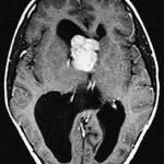 subependymal giant cell astrocytoma associated with tuberous sclerosis