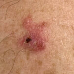 superficial basal cell carcinoma