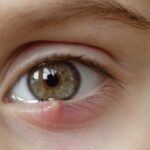 superficial ocular infection