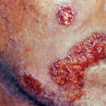 suppression of recurrent herpes simplex infection in hiv