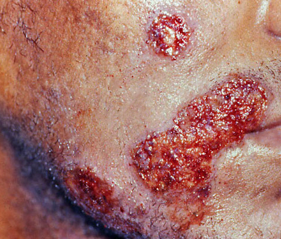 suppression of recurrent herpes simplex infection in hiv