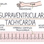 supraventricular arrhythmias