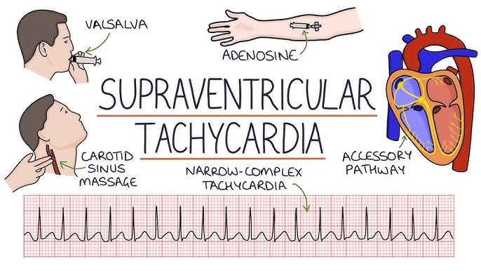 supraventricular arrhythmias