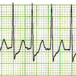supraventricular tachycardia