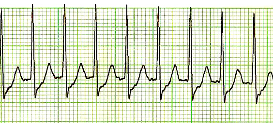 supraventricular tachycardia