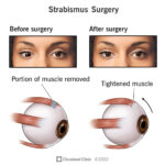 surgical procedure on eye proper