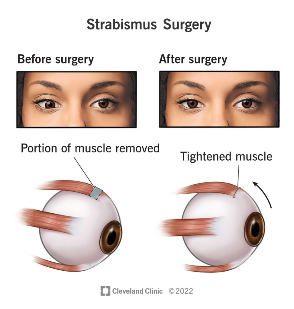 surgical procedure on eye proper
