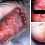 symptomatic congenital syphilis