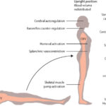 symptomatic orthostatic hypotension
