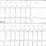 syncope due to heart block